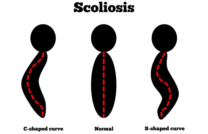 Worcester, MA scoliosis treatment